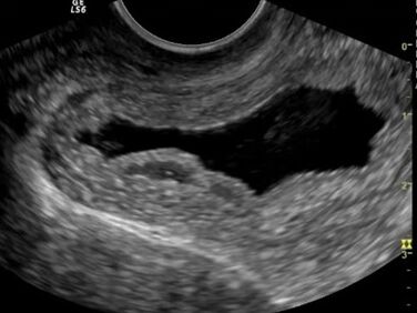 Ultrasound examination showed chronic cystitis