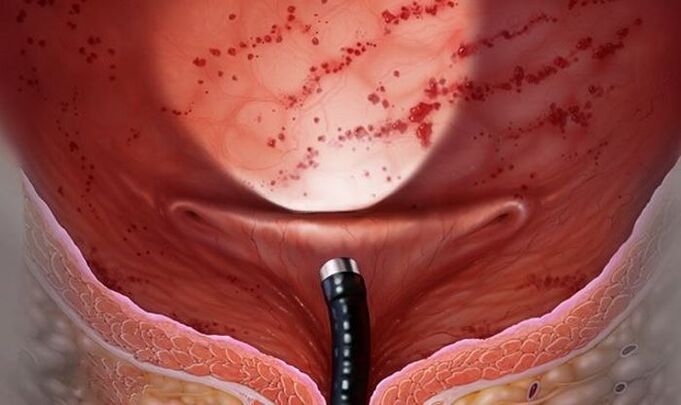 cyst