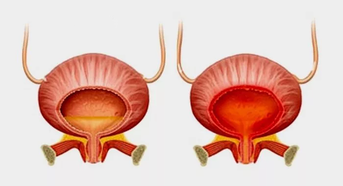 Normal bladder (left) and inflammation of the bladder with cyst (right)